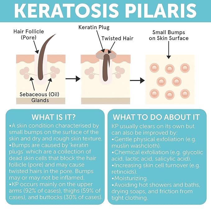 KP Bump Eraser Body Set | Keratosis Pilaris Treatment | Keratosis Pilaris Lotion | Exfoliating Body Scrub | Ingrown Hair Treatment | Bundle Set for Bump, Strawberry Legs, Redness, Dry & Flakey Skin