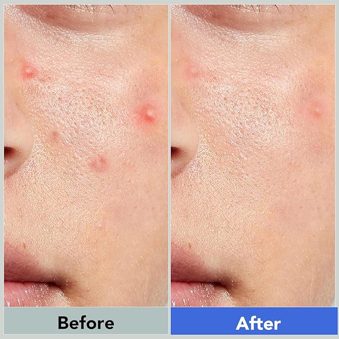 Pimple Patches for Face,Acne Patches for Face,Pimple Patch,Zit Patches,Hydrocolloid Blemish Patches for Covering Zits ,with Salicylic Acid,Tea Tree oil & Calendula oil (106 Counts, Count, 106.0)