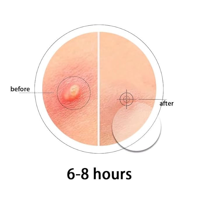 Hydrocolloid Acne Pimple Patch - Overnight Whiteheads & Blemishes - Acne Pimple Patches for Face - Nighttime Zit Stickers for Face | Shrinks Pimples, Invisible Spot for Clear Skin | 72 Count