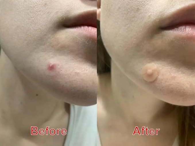 Hydrocolloid Acne Pimple Patch - Overnight Whiteheads & Blemishes - Acne Pimple Patches for Face - Nighttime Zit Stickers for Face | Shrinks Pimples, Invisible Spot for Clear Skin | 72 Count