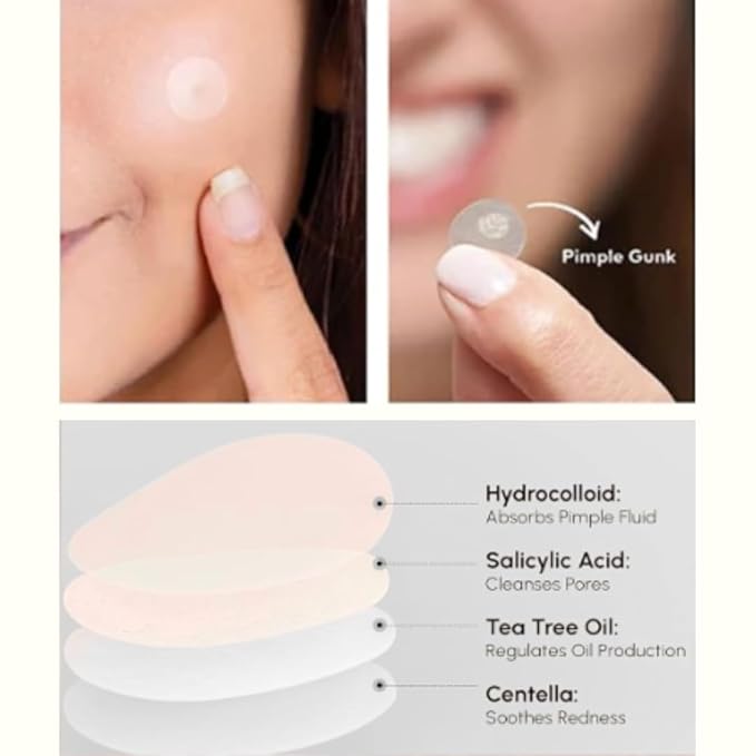 Clear Pimple Patches – 72 Ct Hydrocolloid Acne Patches w/ Salicylic Acid & Tea Tree Oil – Fast-Acting Zit Stickers for Face, Blemish & Spot Treatment – Invisible, Waterproof & Gentle for All Skin