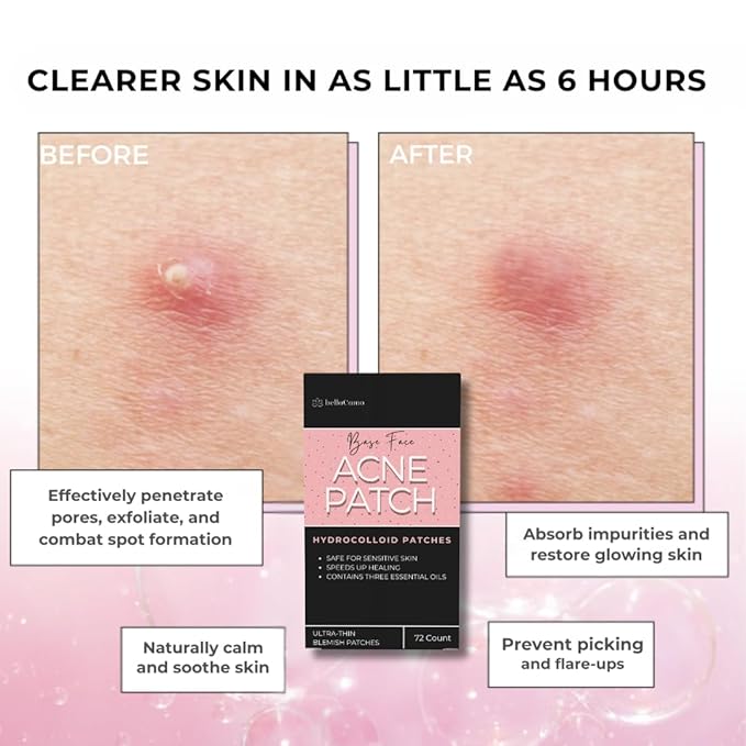 Clear Pimple Patches – 72 Ct Hydrocolloid Acne Patches w/ Salicylic Acid & Tea Tree Oil – Fast-Acting Zit Stickers for Face, Blemish & Spot Treatment – Invisible, Waterproof & Gentle for All Skin