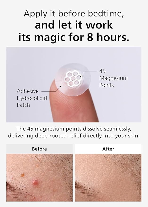 EasyDerm Quick Calming Magnesium Patches – 40 Patches (4 Pack), Hydrocolloid Acne Spot Treatment with Tea Tree & Cica, Bulk Value Pack for Acne-Prone Skin, Ideal for Home Skincare