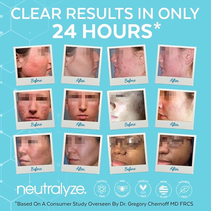 Neutralyze Acne Wash for Face with 2% Mandelic Acid & 2% Salicylic Acid - Professional Grade, A.H.A. + B.H.A. Facial Cleanser for Acne Prone Skin (90+ Day)