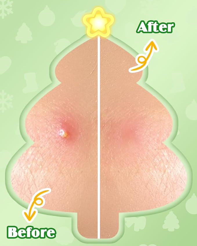 Christmas Cute Hydrocolloid Pimple Patches - Fun Acne Patches for Zits and Blemishes, Pimple Stickers for Face and Skin, Tea Tree Oil & Salicylic Acid, 144 Count