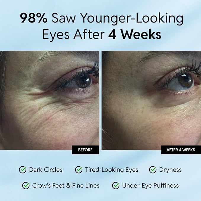 Anti-Aging Eye Cream – Smooths Wrinkles, Firms and Hydrates – With Niacinamide, Ceramides and Caffeine – Reduces Fine Lines, Dark Circles and Puffiness – Dermatologist-Tested -15ml