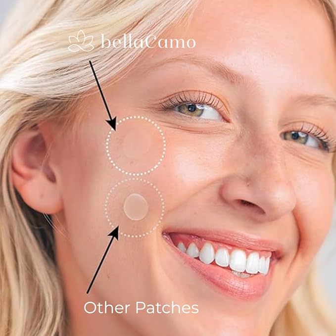 Clear Pimple Patches – 72 Ct Hydrocolloid Acne Patches w/ Salicylic Acid & Tea Tree Oil – Fast-Acting Zit Stickers for Face, Blemish & Spot Treatment – Invisible, Waterproof & Gentle for All Skin