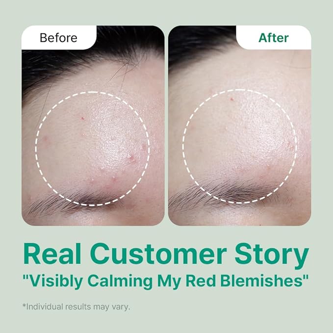 FRANZ Soothing Bubble Toner | Korean Skincare Acne Toner with CICA & Melittin | Calming & Redness Relief Formula | pH 6.0~6.5 Balancing & Oil Control for Sensitive, Acne-Prone Skin