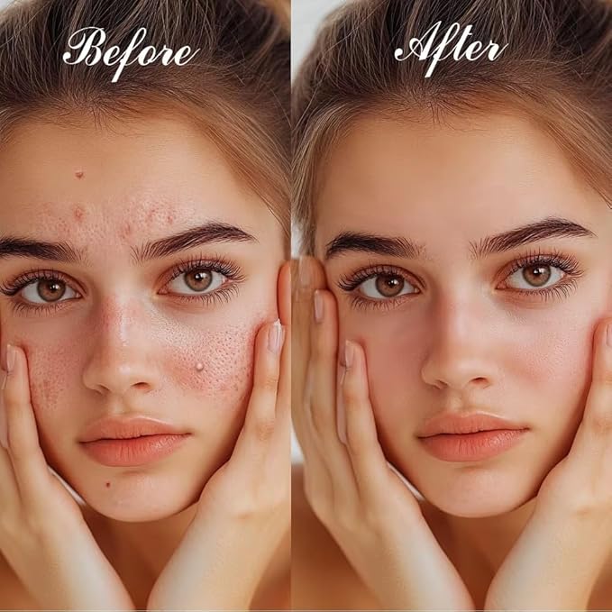 Hydrocolloid Acne Pimple Patch - Overnight Whiteheads & Blemishes - Acne Pimple Patches for Face - Nighttime Zit Stickers for Face | Shrinks Pimples, Invisible Spot for Clear Skin | 72 Count