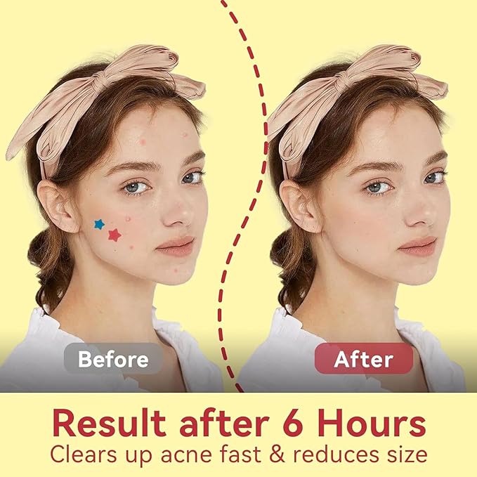 Star Pimple Patches for Face - 6 Colors 66Pcs (14mm) Hydrocolloid Spot Dots, Day & Night Blemish/Zit Healing Pimple Patches
