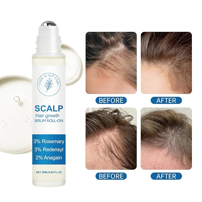 Rosemary Hair Growth Serum Roll On, 3% Rosemary 3% RedensyI & 2% Anagaln Hair Beard Growth Serum, Thicker Stronger Hair Beard, Prevents Hair Fall Stimulates Hair Follicles for All Hair Types - 25ml