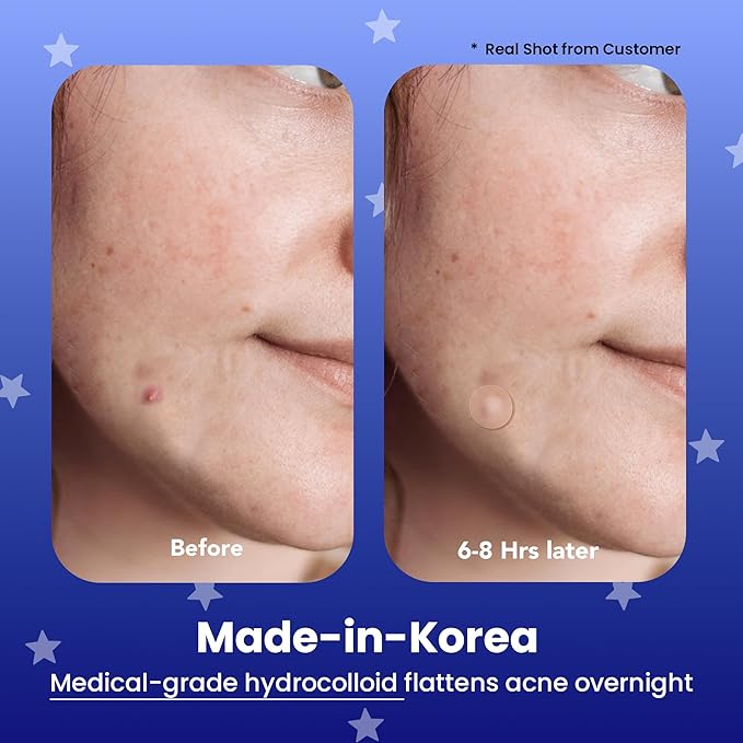 AVARELLE Spot Pimple Patches for Face | Good Night Acne Cover | Hydrocolloid with Tea Tree Oil | Acne Spot Treatment (12-14 mm, 24 ct)