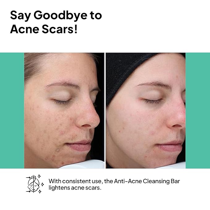 pH Lab Anti-Acne Set, Cleansing Bar, Serum for Acne Prone Face and Skin with Azelaic Acid