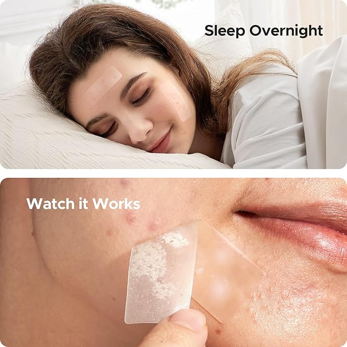 TKTK Large Pimple Patches, 60 mm XL Acne Patches, Big Hydrocolloid Bandages for Body, Face, Forhead, Chin, Neck Zit Breakouts, Hydrocolloid Patch (Square, Strip, Dot 5 Sizes 265 Count)