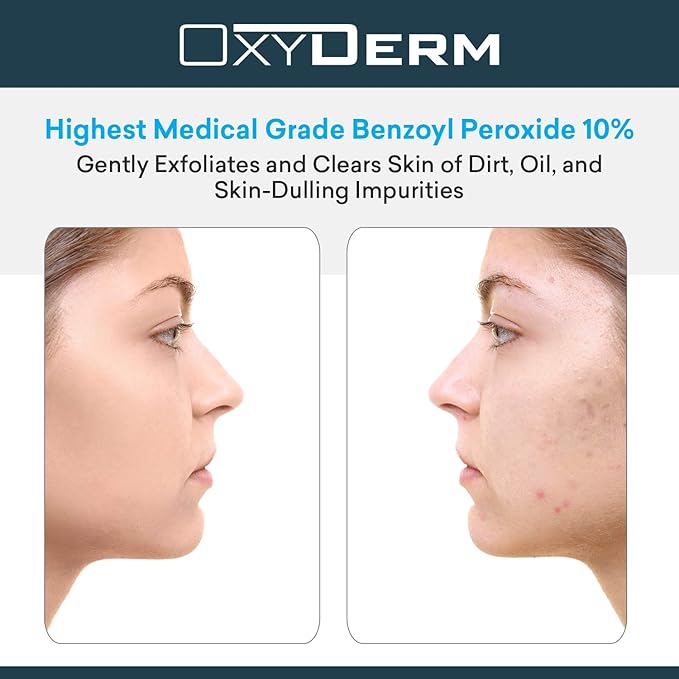 Benzoyl Peroxide 10% Cleanser Wash Treatment - Clears Cystic Breakouts & Fights Acne Blemishes on Contact. Prevents Future Pimples, Blackheads, Whiteheads, Zits, Bumps. Face & Body for Teens & Adults.