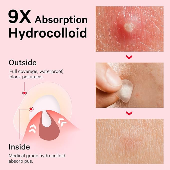 Sosky Pimple Patches for Face, FSA HSA Eligible Invisible Hydrocolloid Acne Patches, Zit Sticker for Face and Skin, Pimple Sticker for Covering Zits, Blemishes with Salicylic Acid 144 Count