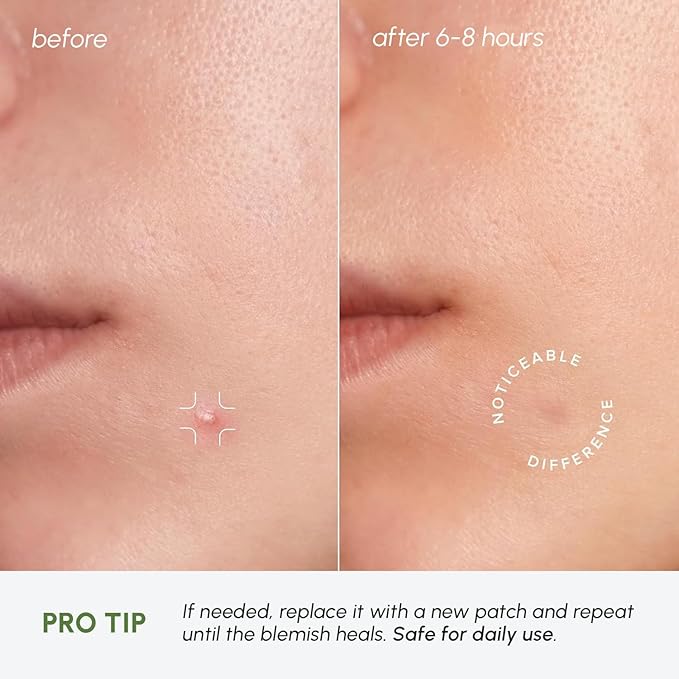 MAREE Invisible Pimple Patches 2 PACK - Clear Pimple Patches for Face - Hydrocolloid Acne Patches Anti Blemish - Zit Stickers for Face - Parches Para Acne - Pinple Zit Pimple Stickers - 144 Dots