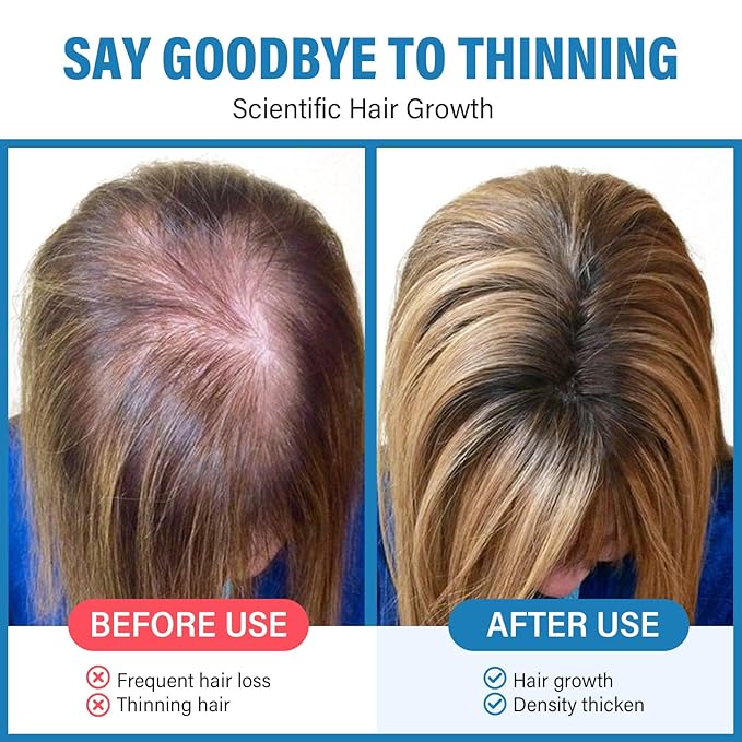 Hair Growth Serum Roll On, Blend with 3% Rosemary, 3% Redensyl, 2% AnaGain, Biotin & Niacinamide, Fast-Absorbing & Non-Greasy, No-Rinse, Advanced Follicle Support for Thinning Hair & All Hair Types