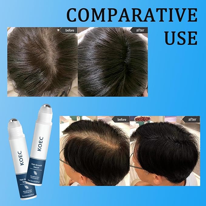 Hair Growth Serum Roll-On,Rosemary Oil Nourishing Scalp Treatment,Reduces Hair Fall and Strengthens Hair,Easy Roller Applicator for Women and Men (1)