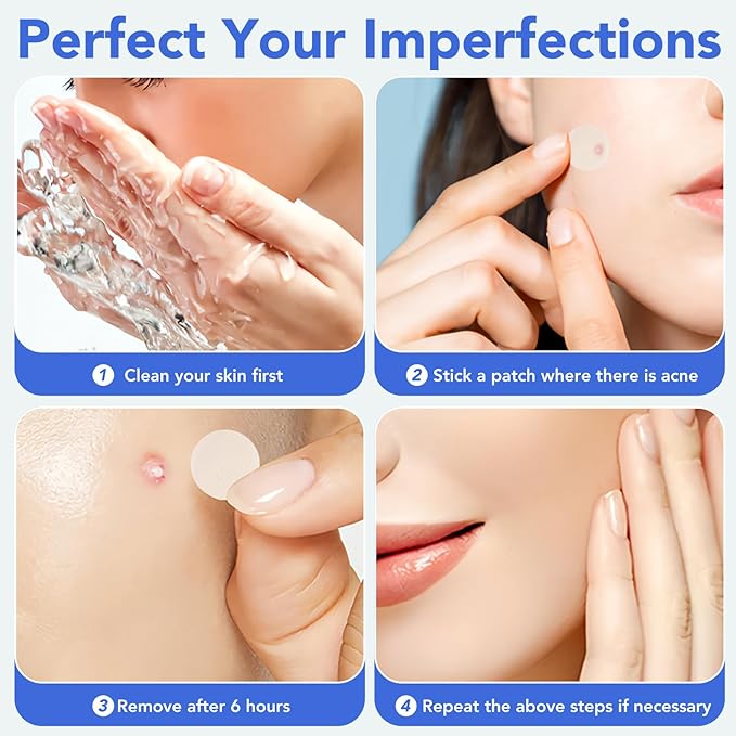 Pimple Patches for Face,Acne Patches for Face,Pimple Patch,Zit Patches,Hydrocolloid Blemish Patches for Covering Zits ,with Salicylic Acid,Tea Tree oil & Calendula oil (108 Counts, Count, 108.0)