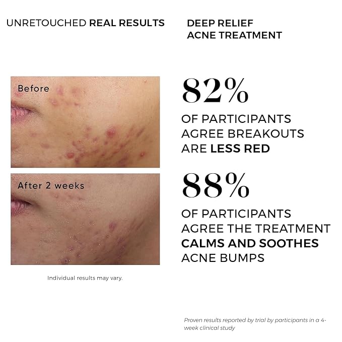 Acne Treatment Pads- Contains Salicylic, Glycolic, & Lactic Acid for Face & Body. Clears Away Clogged Pores, Oily Skin & Cystic Breakouts. Removes Dark Spots, Blackhead & Whitehead Pimples