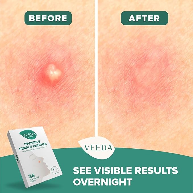 Veeda Glow Pimple Patches – Hydrocolloid Acne Stickers for Fast Healing, Invisible & Non-Irritating Zit Covers, Blemish Spot Treatment, 36 Count