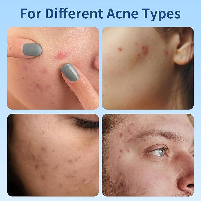 Pimple Patches for Face, 3 Size 306 Counts Acne Patches with Hydrocolloid and Tea Tree Oil, Salicylic Acid Cica Extract Healing Stickers Zit Patches (8mm/10mm/12mm)