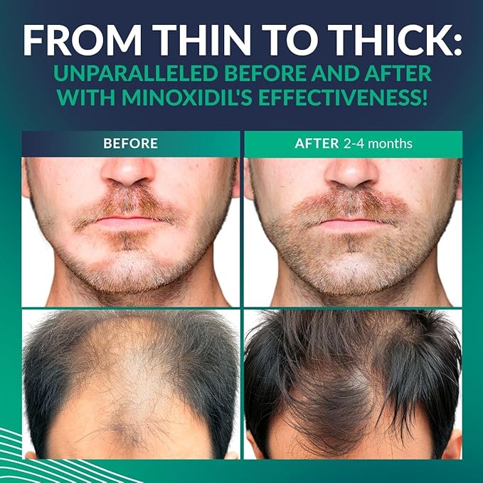 Minoxidil for Men 5% - Hair Growth, Beard Growth Kit Minoxidil 5 Percent + Vitamin E, Ginseng, Ginger Extract, Biotin Hair Growth Serum - Anti Hair Loss, Regrowth Treatment