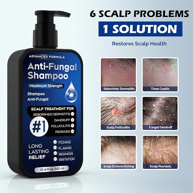Antifungal Shampoo for Seborrheic Dermatitis, Folliculitis & Scalp Psoriasis, Anti-Dandruff Shampoo for Men & Women, Relieves Scalp Itching, Dryness, Sulfate & Paraben-Free, 10.1 Fl Oz