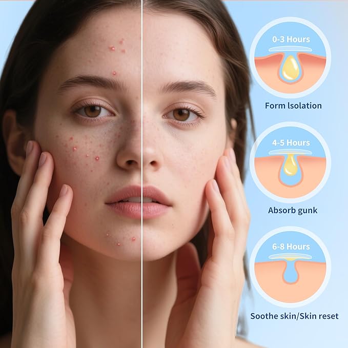 Pimple Patches for Face, 3 Size 306 Counts Acne Patches with Hydrocolloid and Tea Tree Oil, Salicylic Acid Cica Extract Healing Stickers Zit Patches (8mm/10mm/12mm)