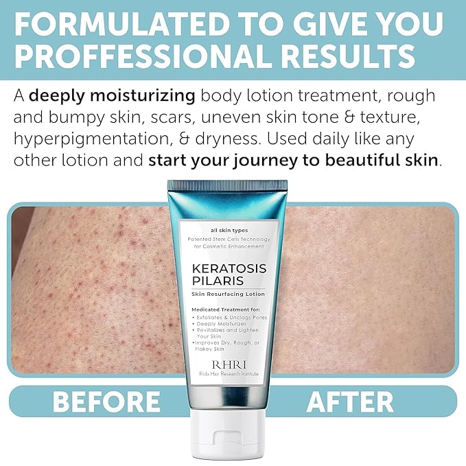 KP Bump Eraser Body Scrub | Keratosis Pilaris Treatment | Bump Eraser Body Scrub | Exfoliating Body Scrun | Ingrown Hair Treatment | Clears Strawberry Legs | Soothes Redness, Dryness & Flaky Skin