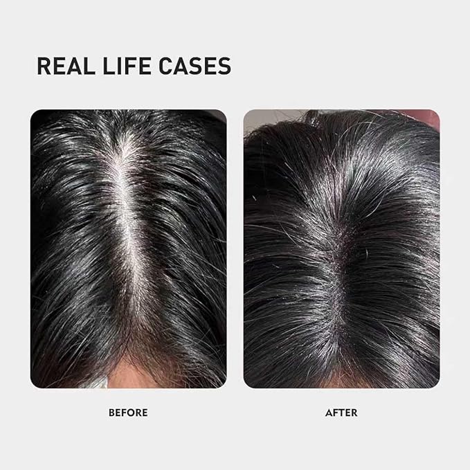 Kintor 0.5% KX-826 Hair Density Serums, DHT Blocker, Hair Repair, Thicker, Strengthening, Fuller-looking Healthier Hair, Reducing Hair Loss, for Men and Women, for All the Day, 60ml