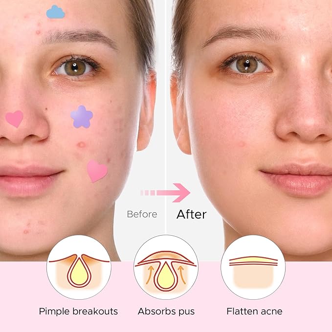 LitBear Acne Pimple Patch, 360 Dots 3 Shaped Colors Pimple Patches with Salicylic Acid, Tea Tree Oil & Calendula Oil, Hydrocolloid Acne Patch for Face, Blemish, Cute Zit Patch Pimple Sticker Acne Dots