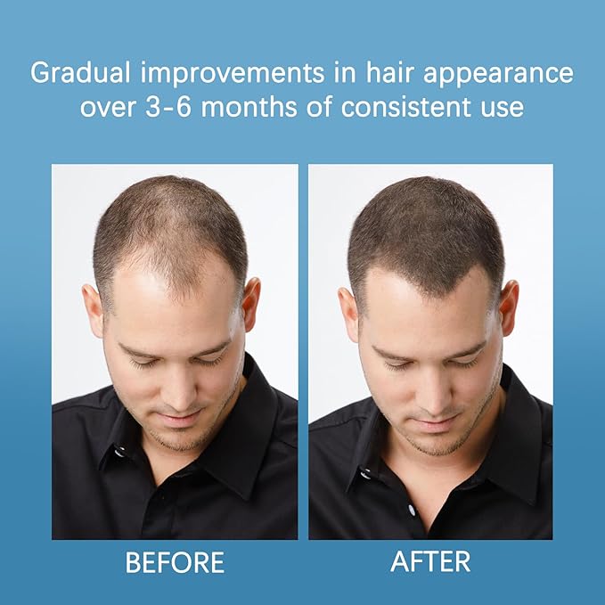 Hair Growth Serum Roll On – Rosemary & Peptide Formula for Thicker Hair, Fast-Absorbing & Non-Greasy, Advanced Follicle Support 0.85 Fl Oz (1 Pcs)