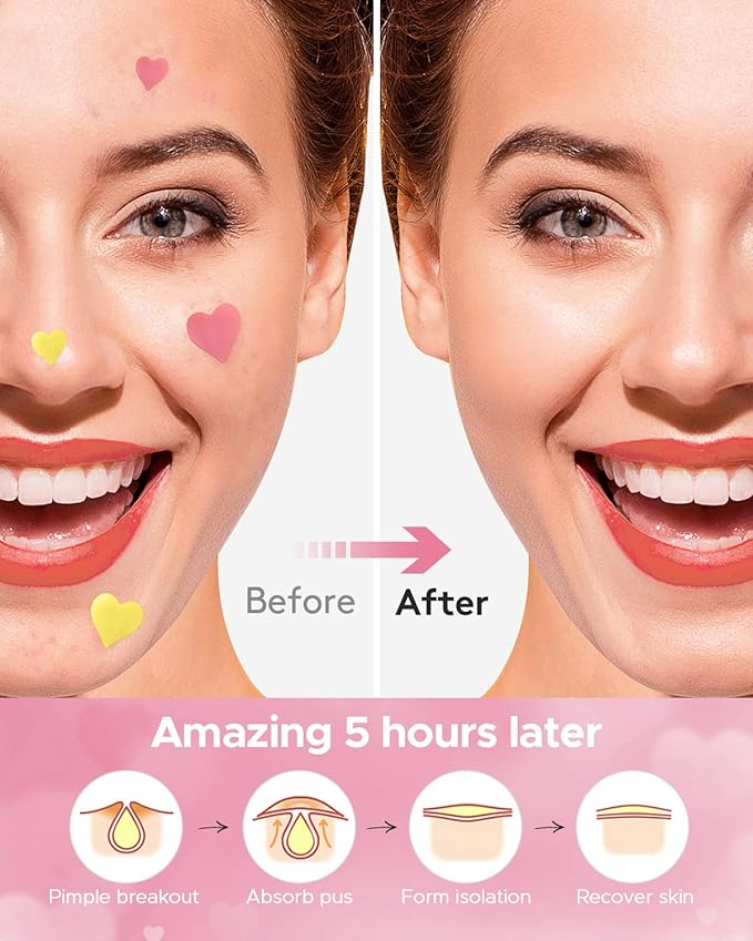 LitBear 3 IN 1 Pimple Patches for Face, 7 Sizes 368 Counts Acne Patches, Hydrocolloid Patches for Covering Zits and Blemishes, Cute Zit Patches for Breakouts, Colorful Spot Stickers for All Skin Types