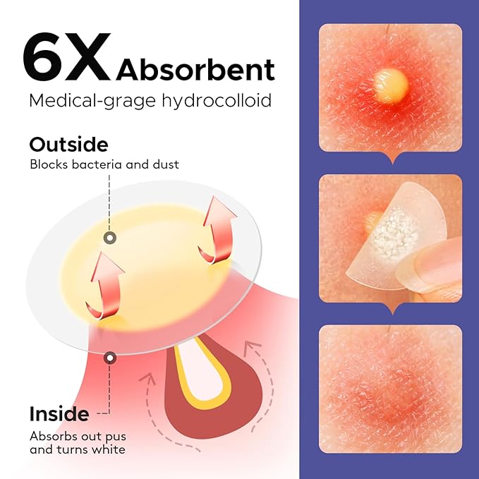 LitBear Acne Patches for Large Breakouts, Hydrocolloid Pimple Patches for Zit and Blemish, Face, Chin, Back and Body With Tea Tree Oil (Pack of 2)