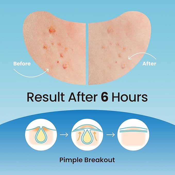 DERMA ANGEL Large Pimple Patches for Nose Chin and Forehead Pores Breakout and Spot Treatment - Acne Patches for Face Hydrocolloid Acne Patches Zit Patches for Face Big Pimple Patches - 16 Patches XL