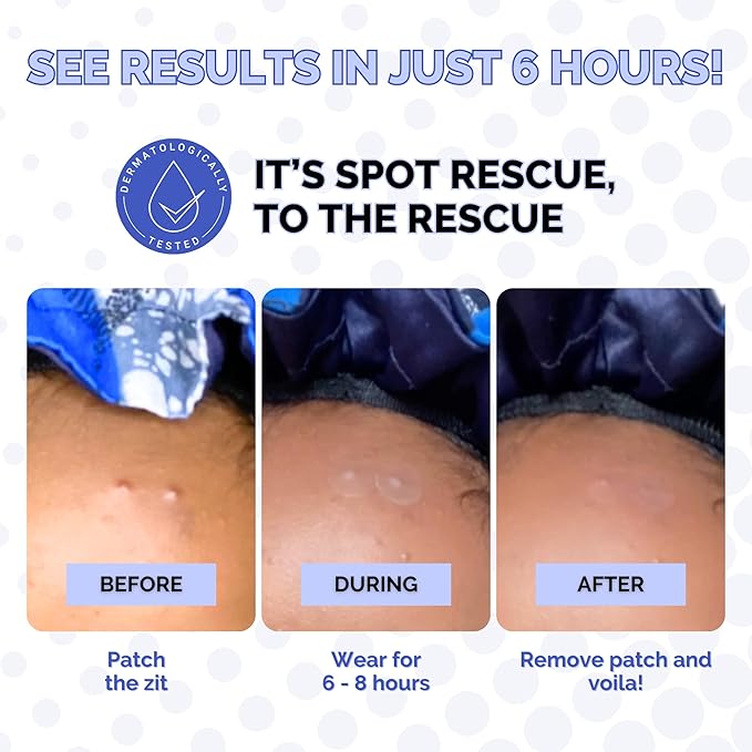 Elizabeth Mott Spot Rescue Blemish Patches - Hydrocolloid Acne Stickers with Salicylic Acid & Tea Tree for Pimples, Zits & Blemishes - Fast Healing, Invisible, Day & Night Wear, Vegan, (36 Count)