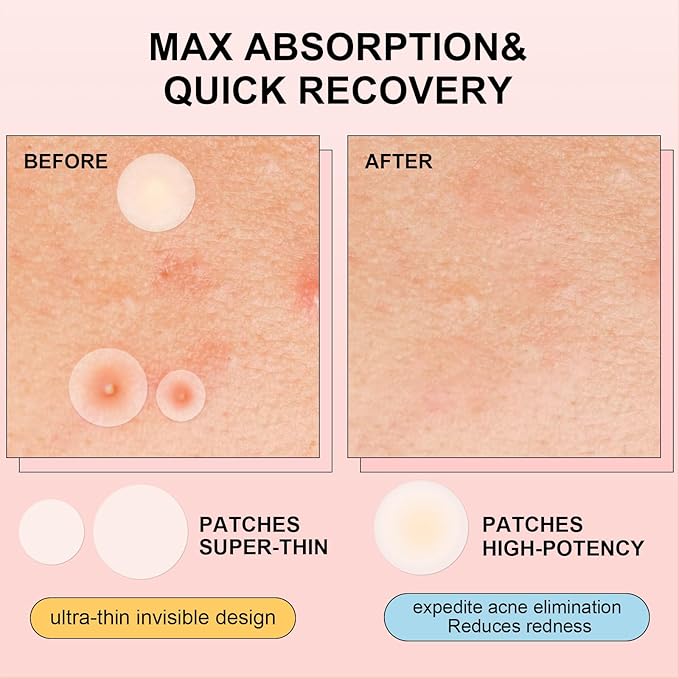 AVJONE Pimple Patches for Face(144 Patches), Hydrocolloid Acne Patches with Tea Tree Oil, pimple stickers for Breakouts, Absorbs Zit, Invisible Spot Cover and Blemish