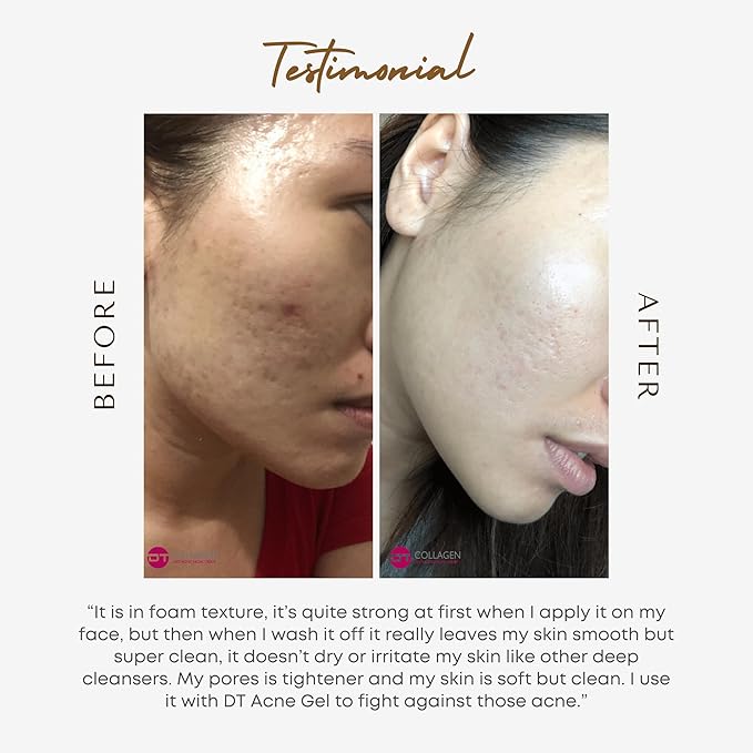 DT Collagen Exfoliating Cleanser with Vitamin B12 – 4oz Deep Cleansing, Acne & Blackhead Treatment, Hydrating & Rejuvenating, Suitable for All Skin Types