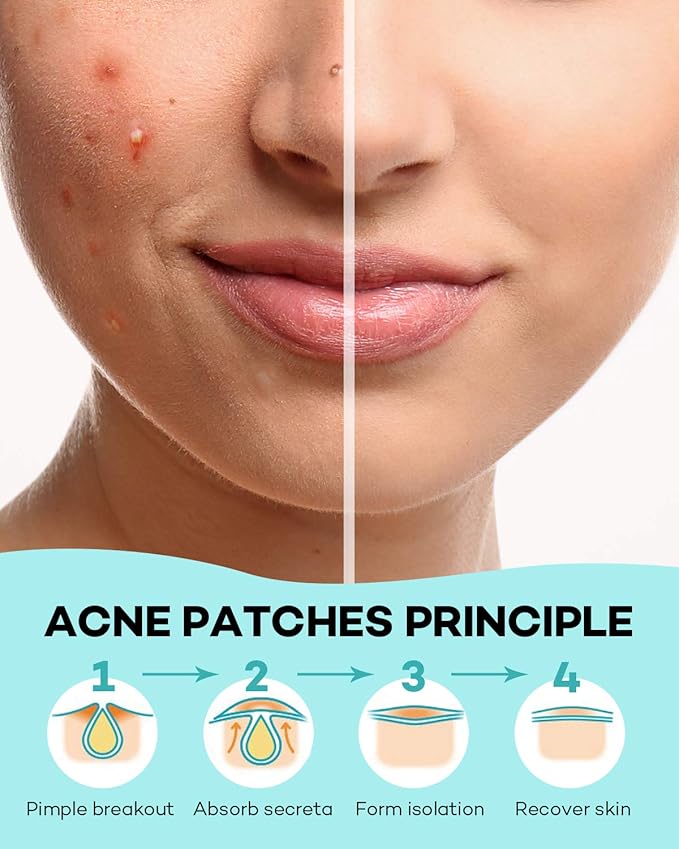 TKTK Pimple Patch Acne Patch, 4 Sizes 140 Patches Acne Absorbing Cover Patch, Hydrocolloid Invisible Acne Patches for Face Zit Patch Acne Dots Tea Tree, Calendula Oil