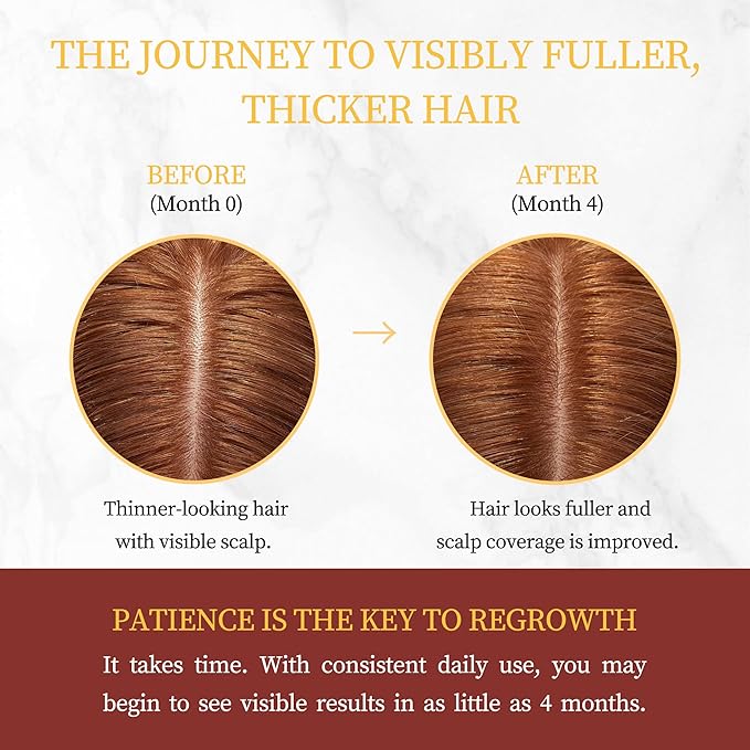Advanced Minoxidil Hair Growth Serum, 2% Minoxidil Topical Solution for Women, Hair Regrowth Treatment for Thinning & Hair Loss, Thicker Fuller Hair, Non-Greasy with Biotin Rosemary Caffeine Ginseng