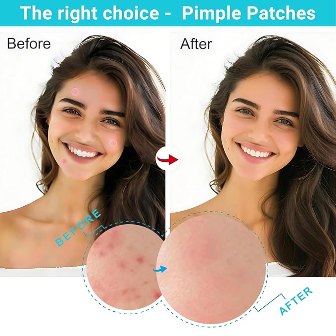 Invisible Pimple Patch, Overnight Miracle Patches for Face & Body, Fast-Acting Zit Stickers, Hydrocolloid Acne Treatment with Tea Tree Oil & Salicylic Acid–Waterproof, Hypoallergenic. 96 Pcs 3 Sizes