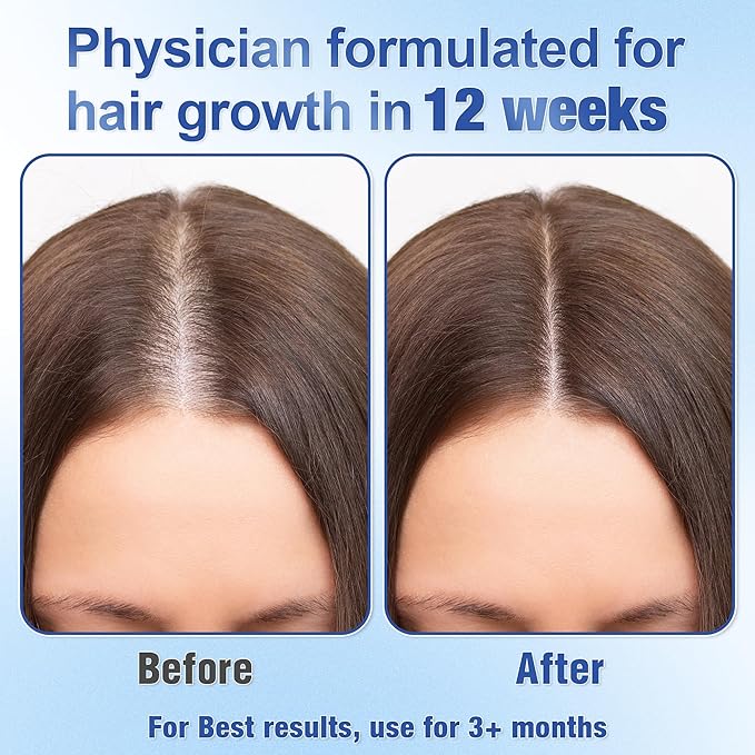 Hair Growth Serum Roll-On (25ml) Powered by 3% Rosemary, 3% Redensyl & 2% Anagain, DHT Blocker for Stronger, Thicker Hair, Paraben, Sulfate-Free, Suitable for Men & Women