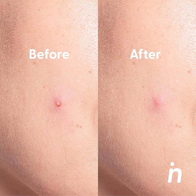 NIPSKIN - Spot Me Here Invisible Hydrocolloid Granite Patches - Waterproof Zit Stickers for All Skin Types