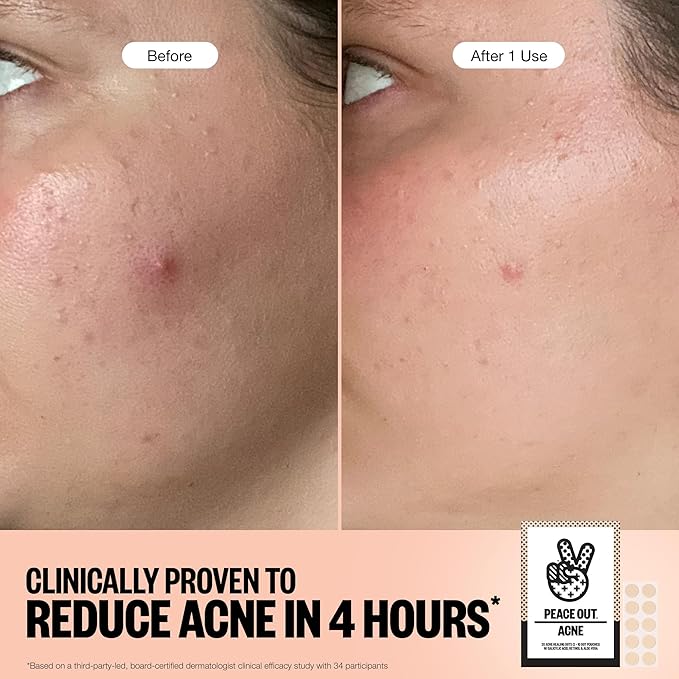 PEACE OUT Acne Healing Dots Helps Clear Blemishes Overnight, Fast Acting Hydrocolloid Pimple Patches for Breakouts with Salicylic Acid, Retinol and Aloe Vera, Award Winning Skincare Solution 20 Count