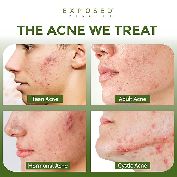 Exposed Skin Care, Expanded Acne Treatment Kit with 2.5% Salicylic Acid and 3.5% Benzoyl Peroxide to Clear Up Teen, Adult, Hormonal and Cystic Acne – Natural, Non-toxic and Cruelty Free