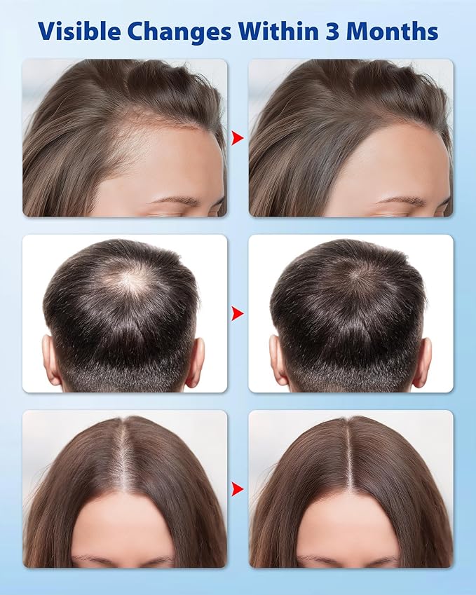 Hair Growth Serum Roll On 30ml – 3% Rosemary, 3% Redensyl，2% Anagain, Niacinamide & Tocopherol | Reduces Hair Loss at the Root for Men & Women | No-Rinse, Non-Greasy, Fast-Absorbing