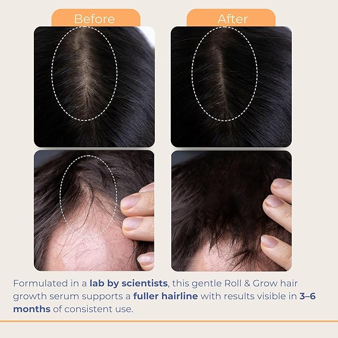 Hair Growth Serum Roll On with Batana, Rosemary & Biotin - Natural Scalp Treatment for Thinning Hair for Men & Women - Non-Greasy Easy Application - 1 fl oz | 30 ml