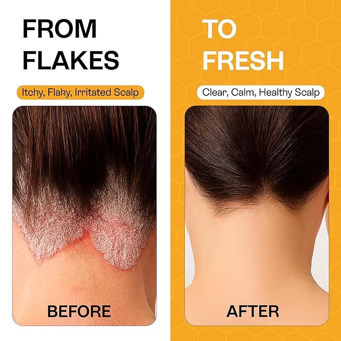Psoriasis Shampoo for Dry & Itchy Scalp - Psoriasis Scalp Treatment for Eczema Relief, Seborrheic Dermatitis, Ringworm & Folliculitis - Itchy Scalp Shampoo for Flakes & Acne with Manuka Honey